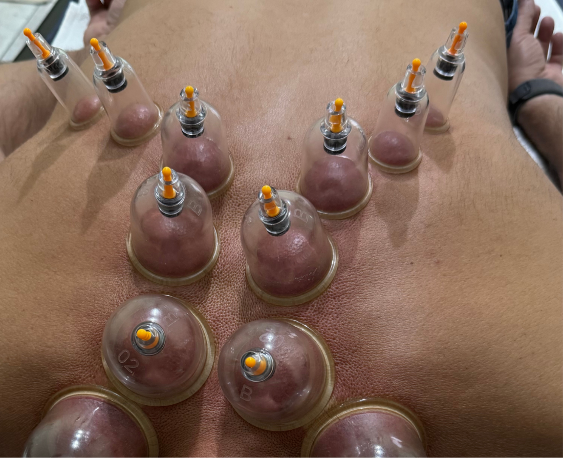 Técnica manual que usa ventosas para criar vácuo na pele, sugando-a e promovendo a melhora da circulação sanguínea, alívio de dores musculares e tensões, esse serviço profisisonal você só encontra na Belle - Cabelo e Estética em Sinop-MT, o melhor preço com uma qualidade excepcional, profissionais com mais de 10 anos de experiência.